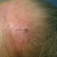 Small SCC on top of scalpThe lesion was only…
