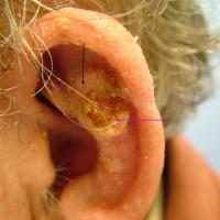 SCC on left ear&nbsp;Much of the lesion is scaly…