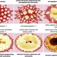 
	Progressive dermoscopic changes 
