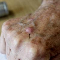 SCC on dorsum of handAlthough this lesion lacked…