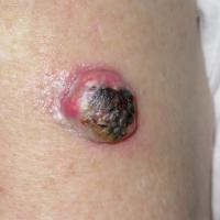 Moderately-differentiated SCCThe lesion had grown…