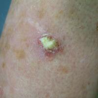 Well-differentiated SCC on the forearmThis lesion…