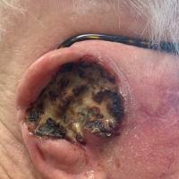 Squamous cell carcinomaSCC requires urgent…