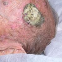 SCC on the left side of the scalp - hidden by…