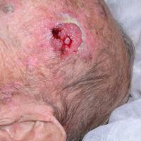 SCC&nbsp; left side of the scalp - same patient…