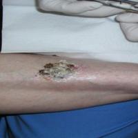 
	SCC on the shin - hidden by scale