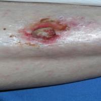 
	SCC on shin - same patient as previous…