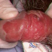 
	SCC of the penis
	
	Copied with kind permission…