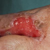 
	Poorly-differentiated SCC
	
	This looked a…