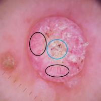 Dermoscopic appearance of previous…