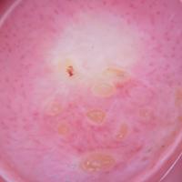 Dermoscopic appearance of previous figureWhite…