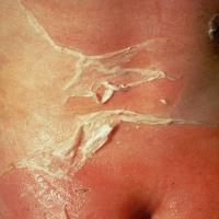 
	Staphylococcal scalded skin syndrome