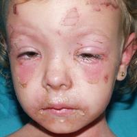 
	Staphylococcal scalded skin syndrome

	Copied…