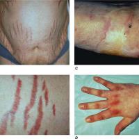
	Clinical features of Cushing&rsquo;s…