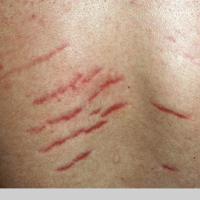 
	Striae in an adolescent male