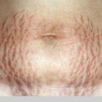 
	Striae in pregnancy&nbsp;