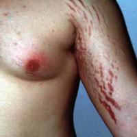 
	Striae