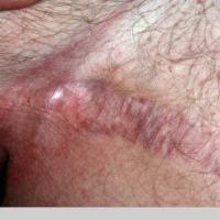 
	Striae in the groin caused by topical…