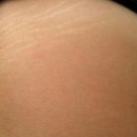
	Striae that have lightened over time
