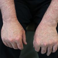 
	Stucco keratoses