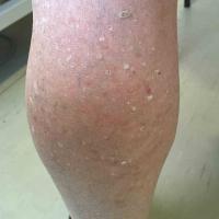 Stucco keratoses
Copied with kind permission…