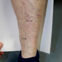
	Stucco keratoses on the lower leg