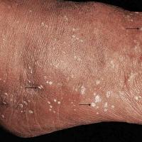 
	Stucco keratoses on the foot
	
	&nbsp;