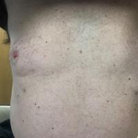 Supernumerary nipple 