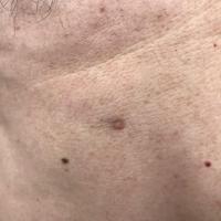 Supernumerary nipple - as previous image

