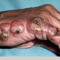 
	Neutrophilic dermatosis of the hands