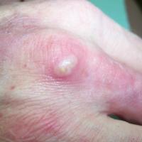 
	Neutrophilic dermatosis of the hands