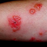 
	Sweet's syndrome with bullous…