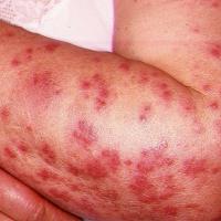 
	Sweet's syndrome - associated with Chron's…