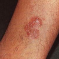 
	Tertiary syphilis - nodular/ tubercular