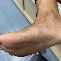 Secondary syphilis - same patient as previous…