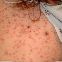 
	Secondary syphilis