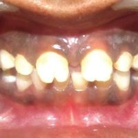 
	Congenital syphilis - Hutchinson's teeth