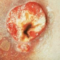 
	Tertiary syphilis - gumma