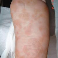 
	Secondary syphilis