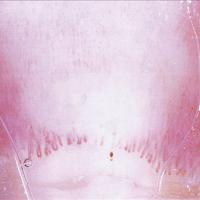 
	An abnormal nailfold capillary pattern…
