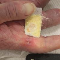 
	As previous image - calcinosis

	The patient…