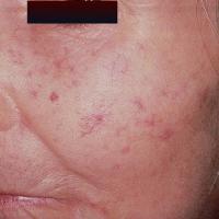 
	The CREST syndrome - telangiectases