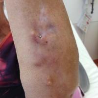 
	Systemic sclerosis - calcinosis