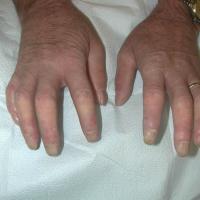 Systemic sclerosis - sclerodactyly