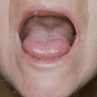 
	Systemic sclerosis

	The mouth opening has…