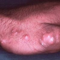 
	The CREST syndrome - calcification