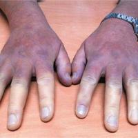 
	Raynaud's phenomenon