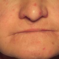 
	Systemic sclerosis

	Small mat-like…