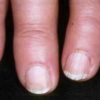 
	Systemic sclerosis - enlargement of capillary…