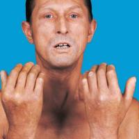 
	Systemic sclerosis